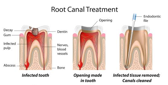 An illustration of a root canal treatment process, showcasing the removal of infected pulp and filling of the tooth.